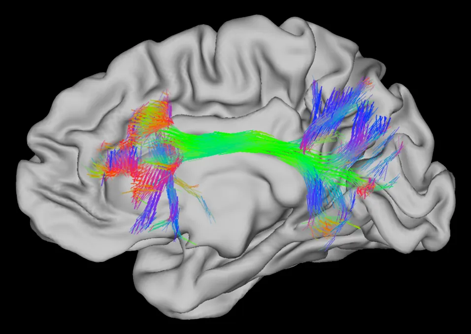 Brain white matter tractography showing neural fiber connections radiating from a seed in the left frontal cortex, color-coded by direction